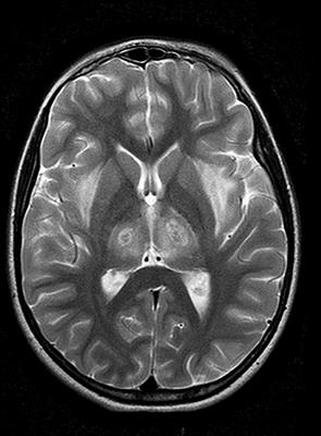 Post-Infectious Autoimmunity in the Central (CNS) and Peripheral (PNS) Nervous Systems: An African Perspective